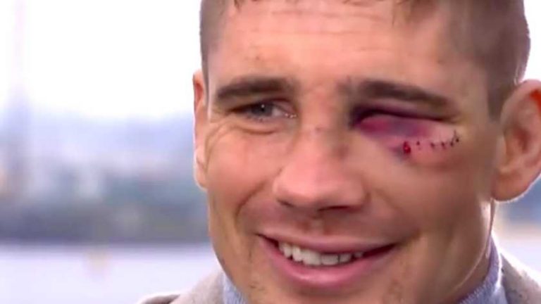 Rico Verhoeven toont gehavende gezicht en vertelt over belletje met Max Verstappen